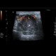 Histiocytoma, recurrence, malignant histiocytoma: US - Ultrasound
